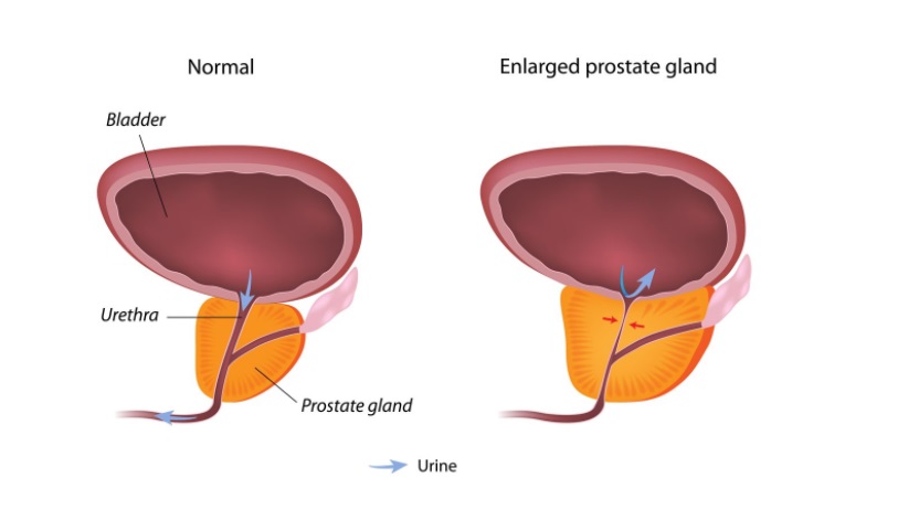 enlarged prostate